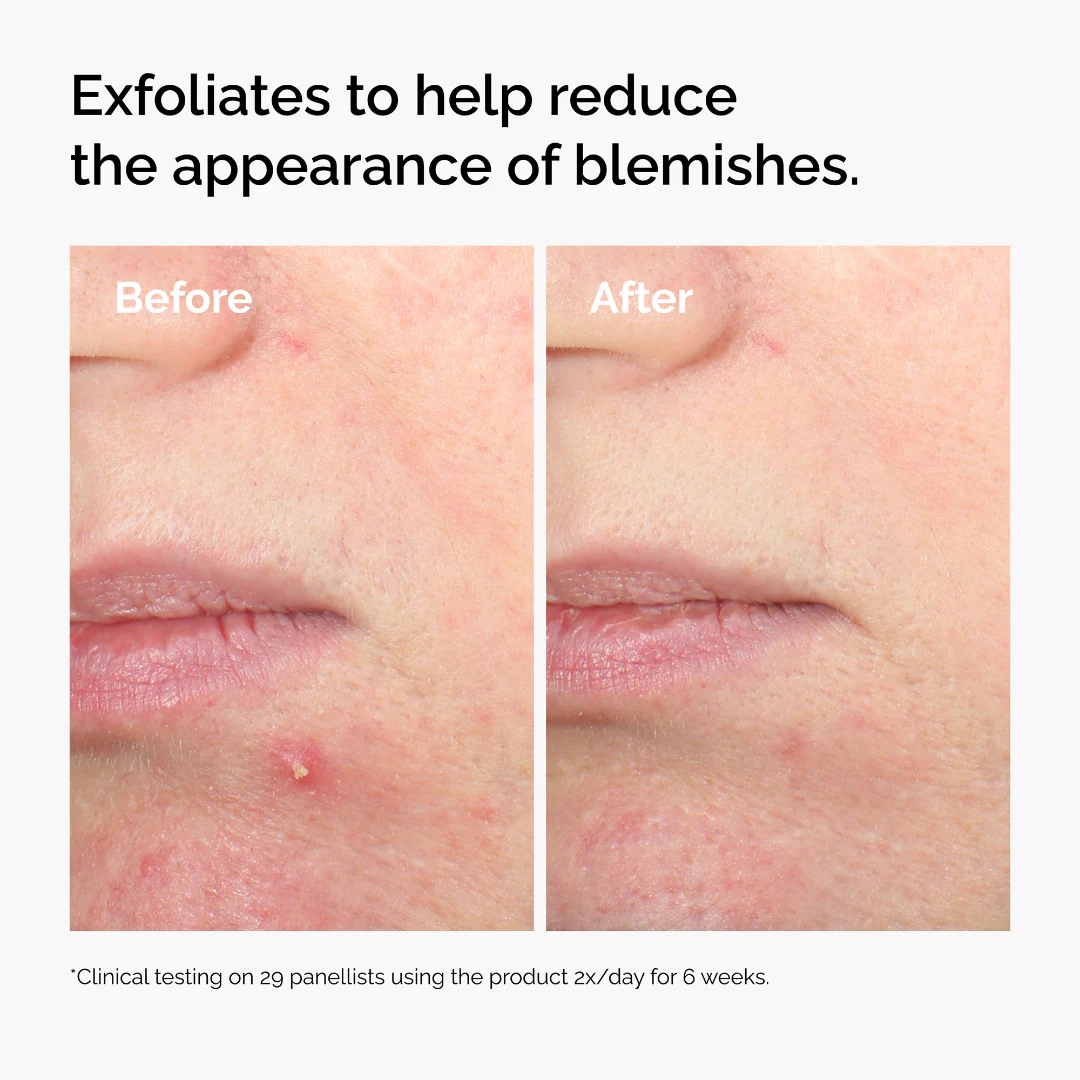 The Ordinary Salicylic Acid 2% Solution - Image 3